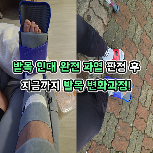 발목 인대 완전 파열 판정받고 지금까지 발목 변화 살펴보기!