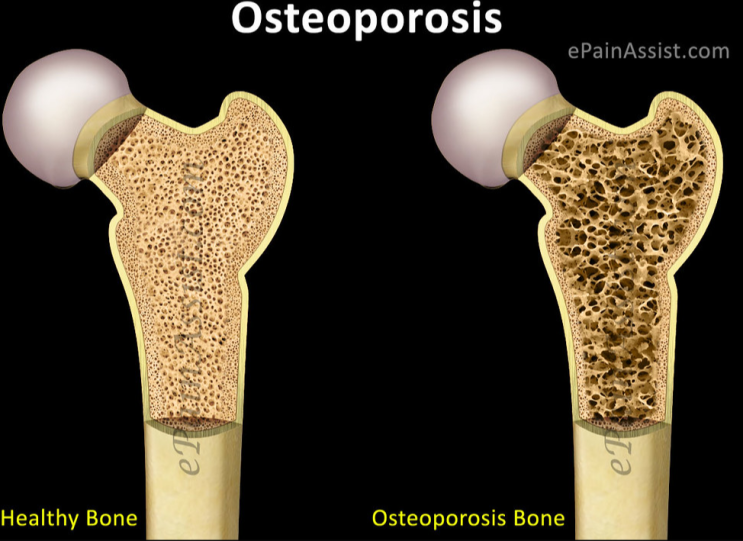 의사들도 인정한 놀라운 MBP 효능, 부작용, 복용량