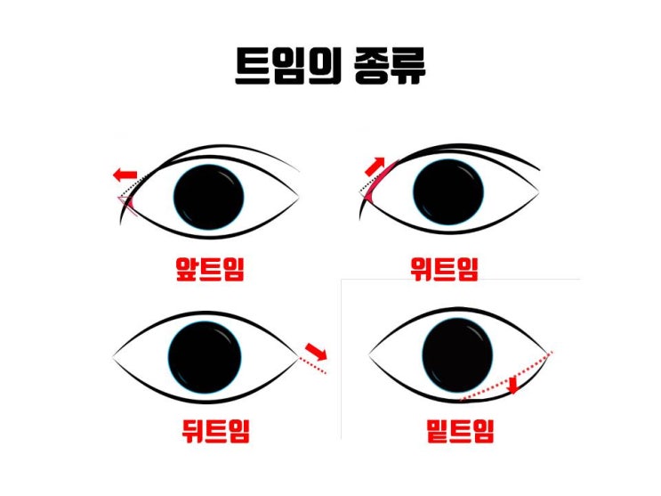  사방트임, 풀트임, 서클트임이 어떤 수술일까요?