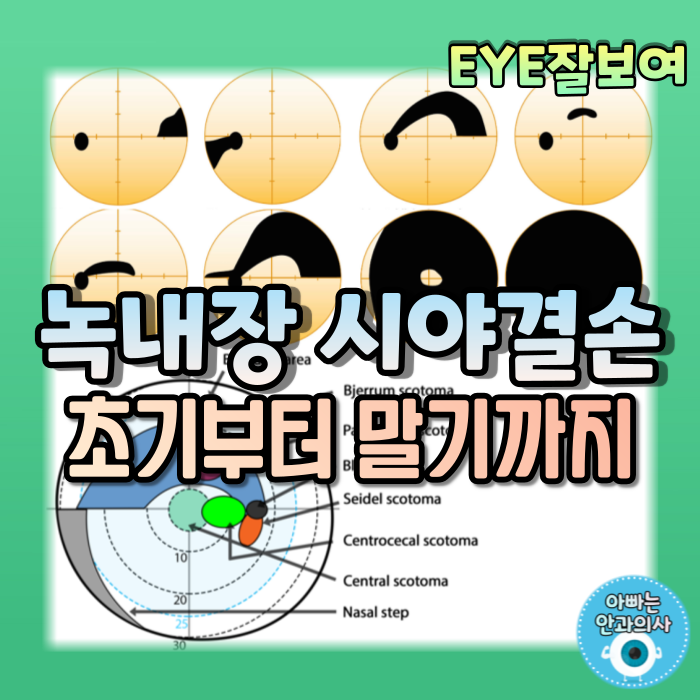 [EYE잘보여] 녹내장 환자의 시야 - 녹내장성 시야결손(Glaucomatous Visual Field Defects)