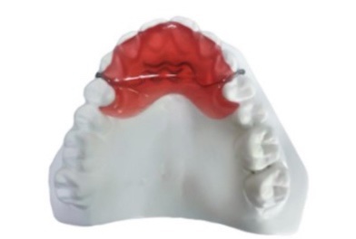 30대 중반 치아 교정일기 과개교합 D-20
