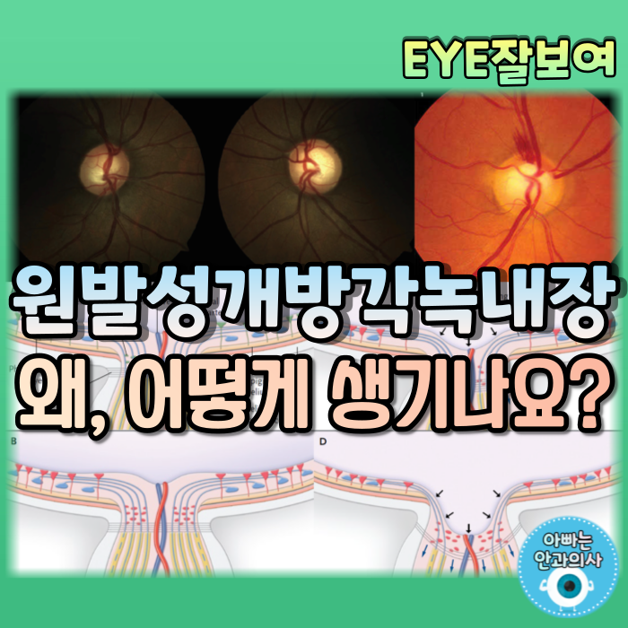  [EYE잘보여] 원발성개방각녹내장(POAG) (1) - 정의, 역학, 위험인자, 발병기전