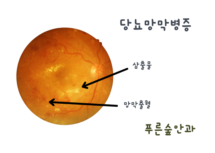  당뇨가 있는데 왜 안과에 가야 하나요? 장산역 안과에서 알려드립니다.
