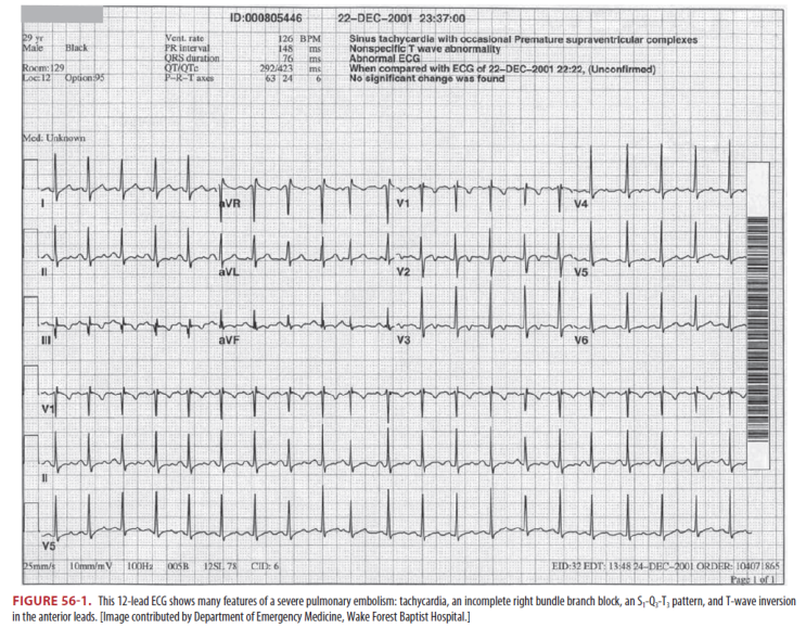  PTE (pulmonary thromboembolism)