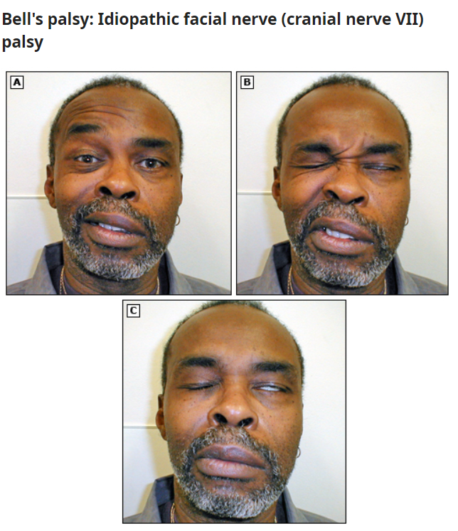 Bell's palsy - facial n. palsy.