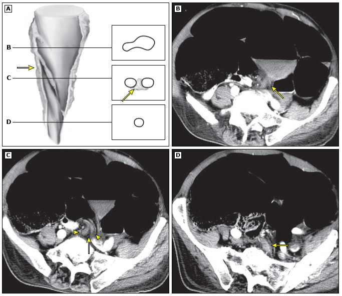  Sigmoid volvulus