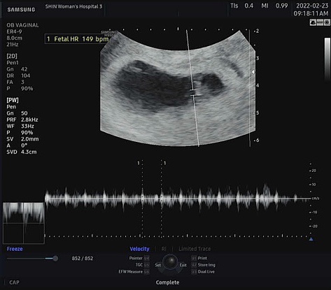 [임신7주] 아기 심장소리 확인 + 7주차 증상 + 임신성 고혈압..?