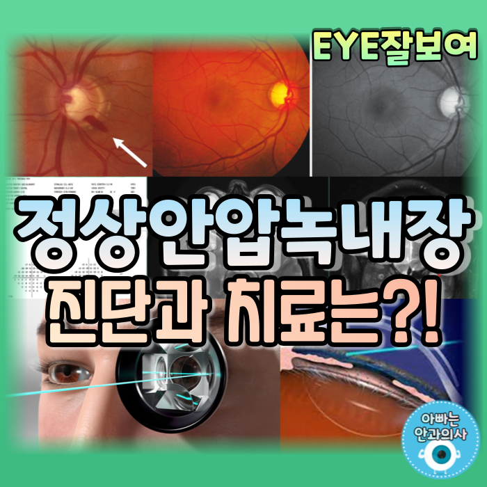  [EYE잘보여] 정상안압녹내장(NTG) (2) - 진단 및 감별진단(감별해야할 질환들), 치료(약물, 레이저, 수술)