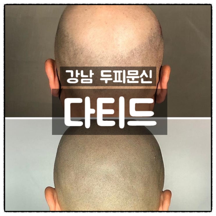  강남두피문신 두피타투 전문점 다티드