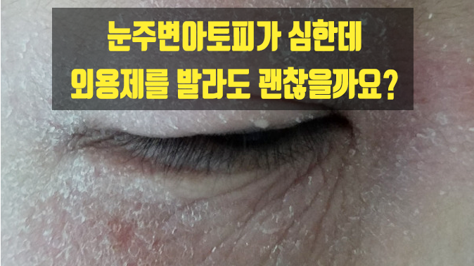  눈주변아토피가 심한데 외용제를 발라도 괜찮을까요?