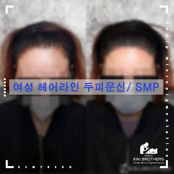  헤어라인을 매끈하게~헤어라인 두피문신/SMP 전문점 키키브라더스 노원