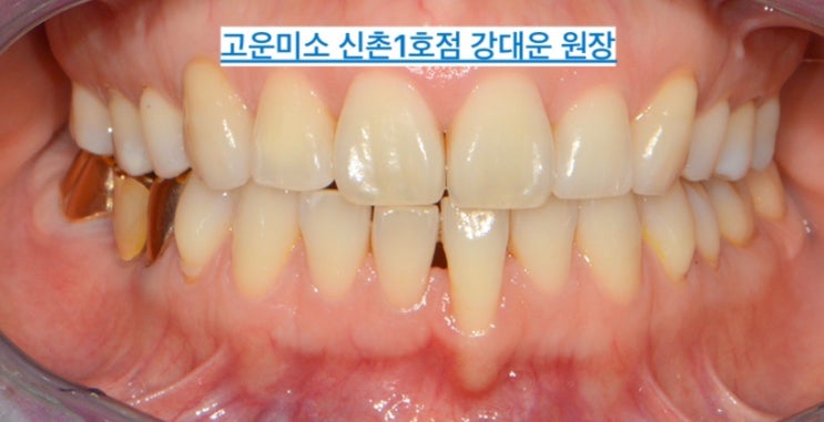  [부분교정] "잇몸"이 내려갔어요