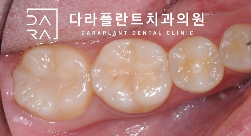 덕양구 사랑니 발치 신경에 가까운 매복치아 발치.고양시 치과 5