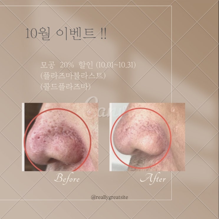  [대구아미뷰티] 콜드플라즈마 10월 20%할인행사 블랙헤드/  여드름흉터/ 모공수축/ 검버섯 제거 