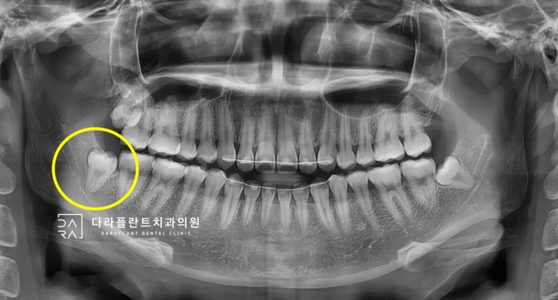 덕양구 사랑니 발치 신경에 가까운 매복치아 발치.고양시 치과 2