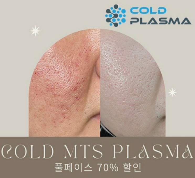  [대구아미뷰티] 콜드MTS 70%할인행사 10월달까지 연장 눈밑꺼짐.주름.모공.기미.탄력을 한번에 해결해드립니다