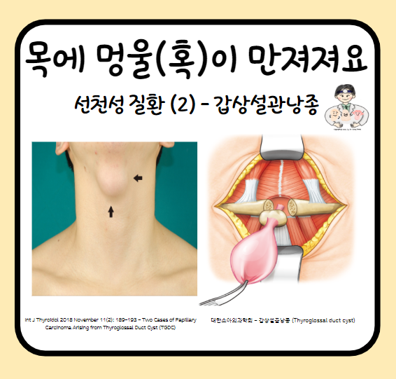  목에서 멍울이 만져져요 (3) - 선천성 경부 종물(Neck mass)과 양성종양 (2) : 갑상설관낭종(Thyroglossal duct cyst, TGDC)