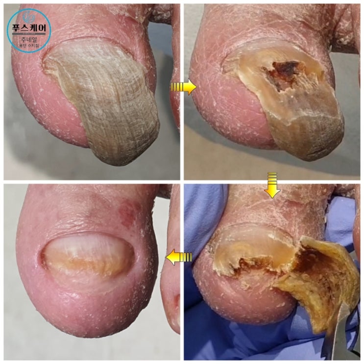 발톱무좀 그냥 방치하시면 이렇게 발가락을 덮을 정도로 변형될수 있습니다./성남수원수지보정동백죽전동/주네일푸스케어용인수지점/무좀발톱염증파고드는내향성발톱손톱변형전문점 발톱무좀 그냥 방치하시면 이렇게 발가락을 덮을 정도로 변형될수 있습니다./성남수원수지보정동백죽전동/주네일푸스케어용인수지점/무좀발톱염증파고드는내향성발톱손톱변형전문점