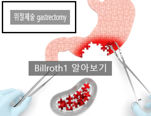 (수술공부)GS:Gastrectomy #1 subtotal:billroth1(위절제술)