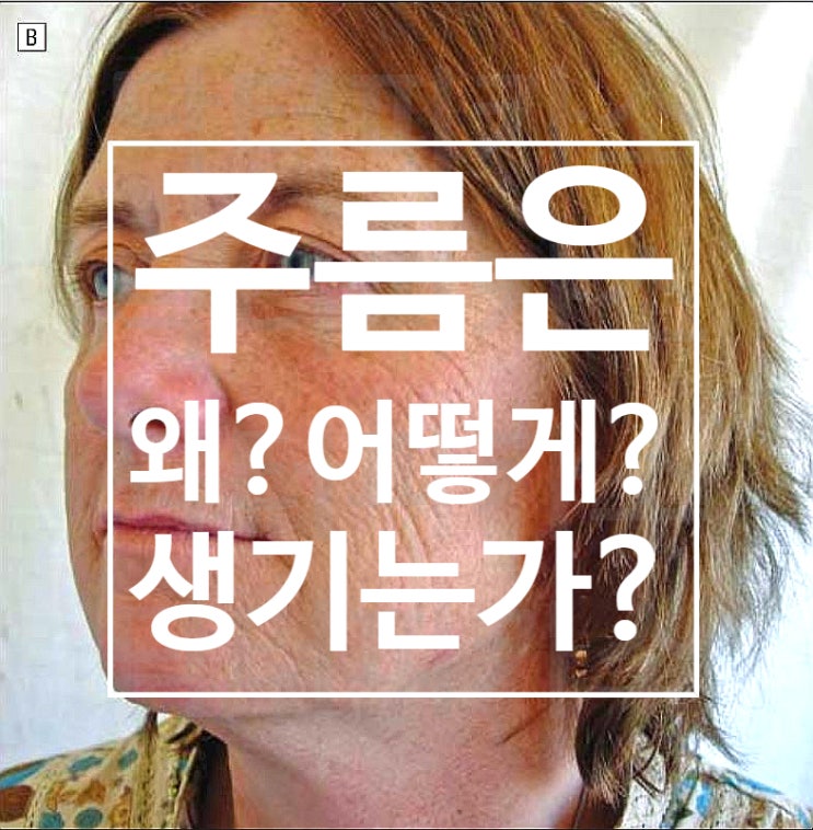  이마 미간 눈가 콧등주름  가 원인!(feat. 항노화의 시작,보톡스 완벽 뽀개기 프롤로그2-1)