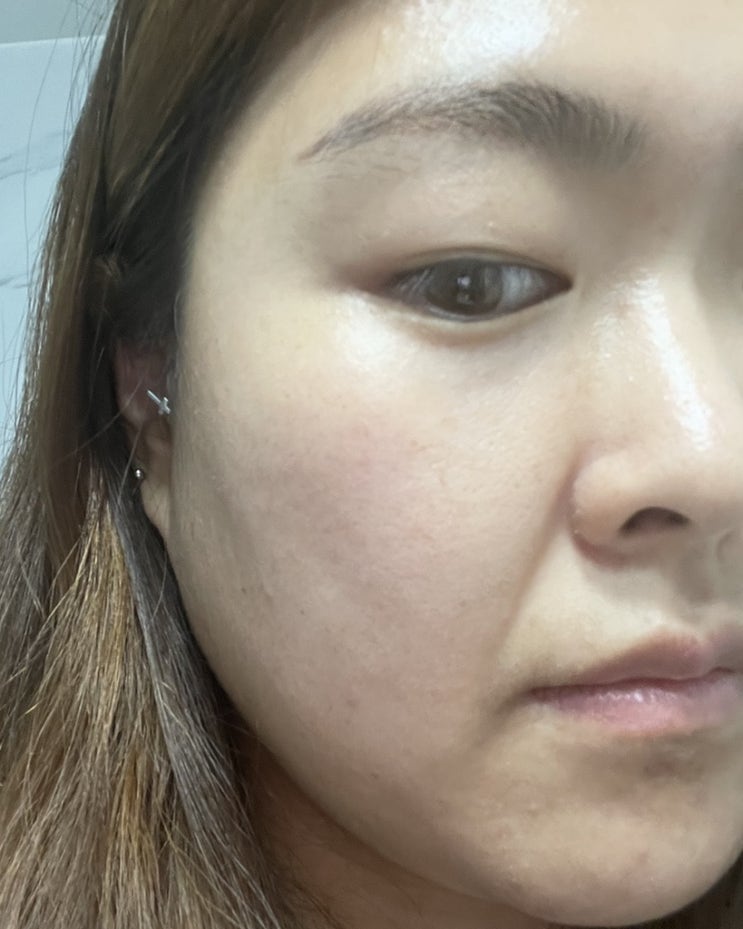  의정부 리쥬란 힐러 후기 - 탄력있고 촉촉한 피부관리