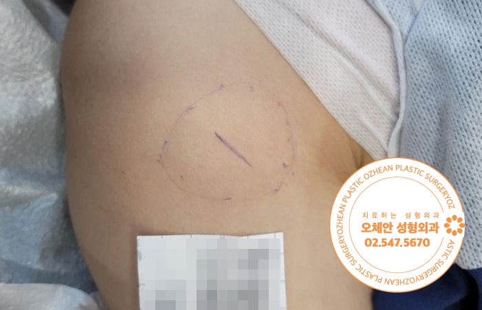 팔에 만져지는 부드러운 혹, 지방종 3