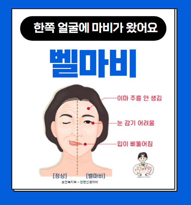  안면신경(Facial nerve) 질환 (2) - 벨마비(Bell's palsy)