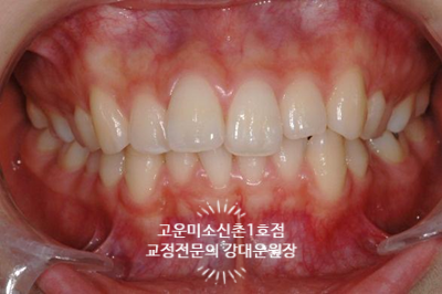  부분교정치료이야기 신촌치과 고운미소신촌1호점 치료증례 기반으로