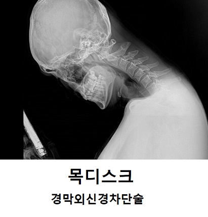  경막외신경차단술 목디스크 신경주사 맞은 후기