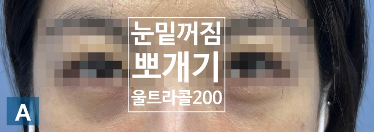  눈밑꺼짐 울트라콜200?필러?스컬트라?(feat.눈밑꺼짐 뽀개기, 눈밑필러, 눈밑지방, 눈밑주름,눈밑처짐)