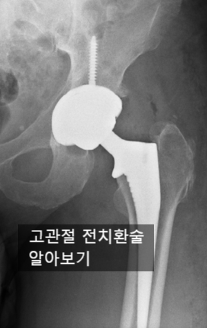  (수술공부)os:Total hip replacement arthroplasty:THRA(고관절전치환술)