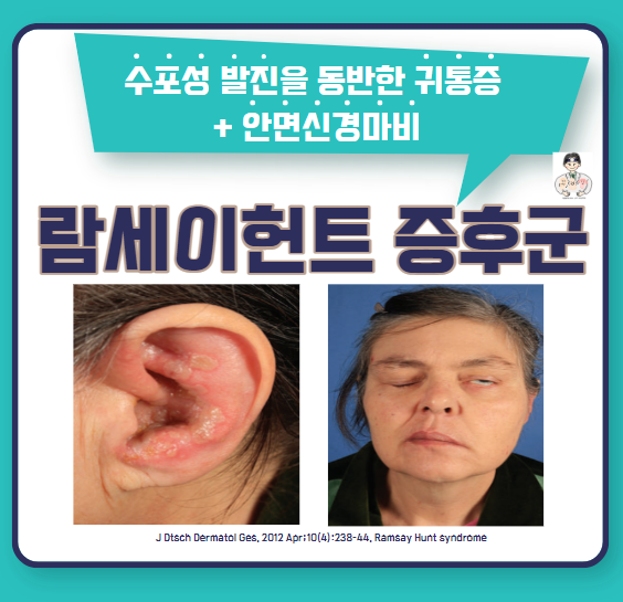  안면신경(Facial nerve) 질환 (3) - 람세이헌트 증후군(Ramsay-Hunt Syndrome, RHS), 뇌졸중 의심증상