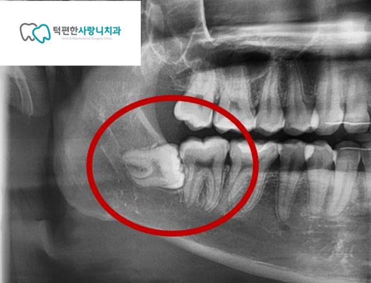  [안양 매복사랑니 당일 발치] 대학병원으로 의뢰되는 힘든 매복사랑니도 당일에 발치하는 이유는?