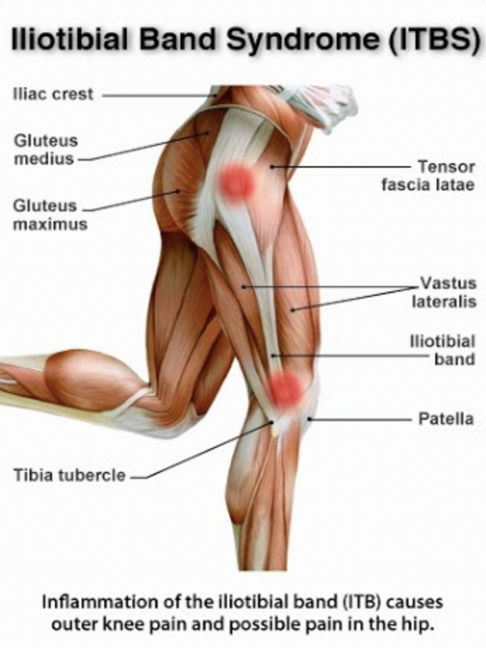 인천통증재활/허벅지 바깥쪽 통증 장경인대증후군 원인 및 운동법