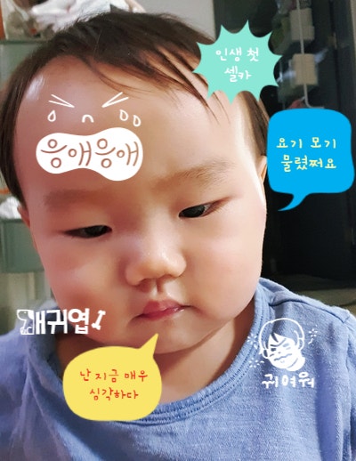 아기 모기알레르기 - 스키터증후군 (모기 물집 수포 & 연고) 아기 모기알레르기 - 스키터증후군 (모기 물집 수포 & 연고)