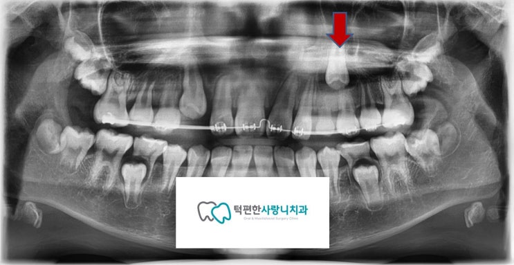 [평촌 구강외과] 교정적 견인을 통해 매복치가 제자리로 가는 과정