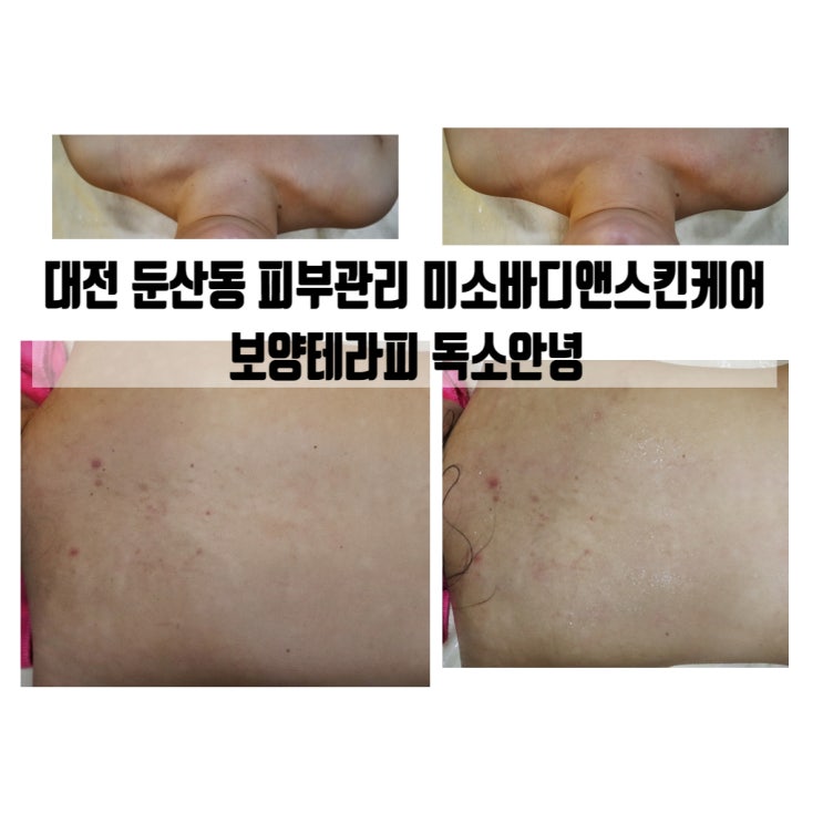  대전 둔산동 피부관리 미소바디앤스킨케어 보양테라피 독소안녕