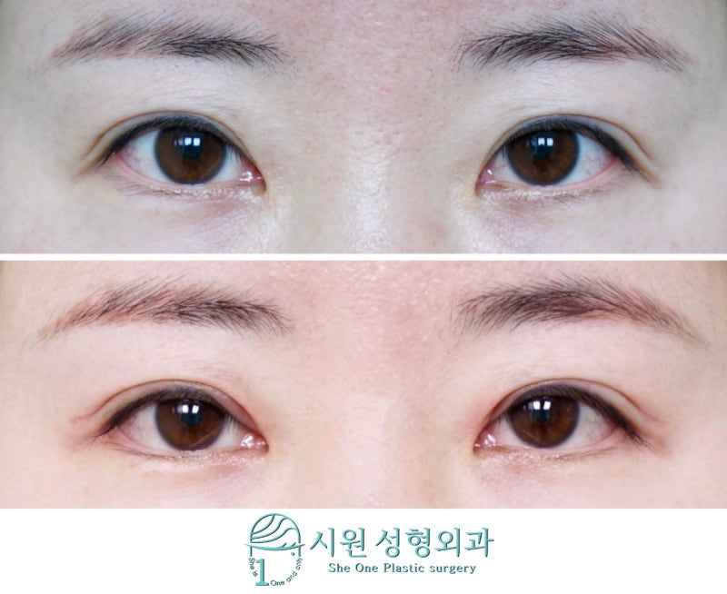 241 뒤트임, 아래트임 9개월차 후기 : 눈꼬리 높이 비대칭, 눈꼬리 높이 조절, 크고 부드러운 눈매로 변화 feat. 시원한 정형외과