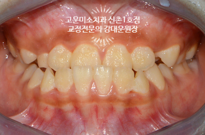  소아주걱턱 교정 가짜 주걱턱 가성 3급부정교합