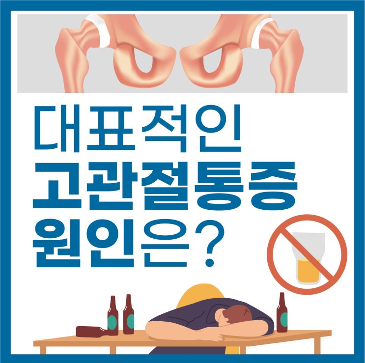  인공관절수술 필요한 고관절통증 원인 : 과도한 음주