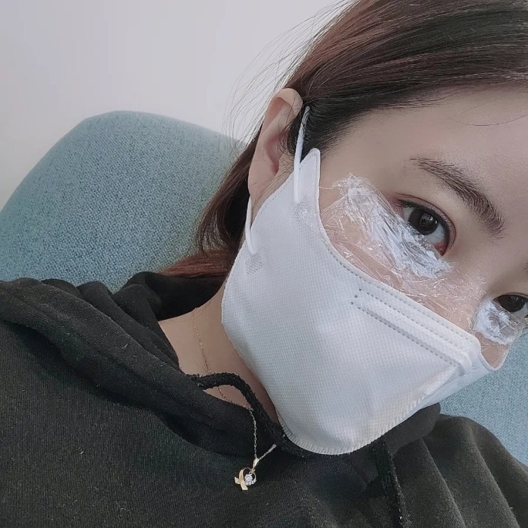  강남역 애교필러 일주일 멍,붓기