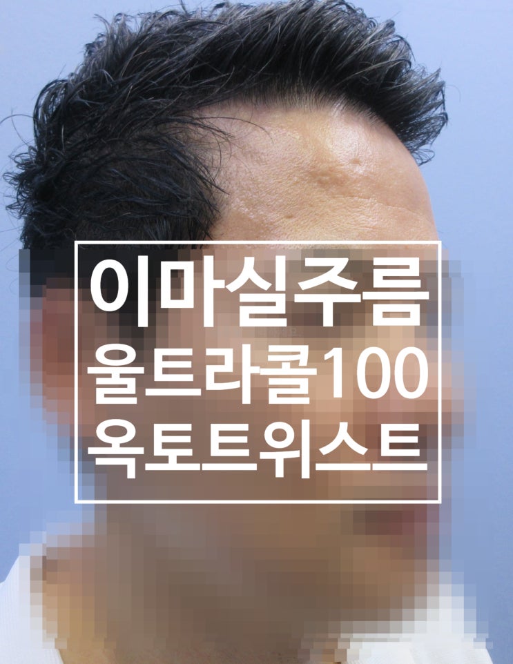 #23.자리잡은 이마주름 시술일기(feat.울트라콜100+옥토실,미간,눈가,이마 실주름/칼주름 치료)
