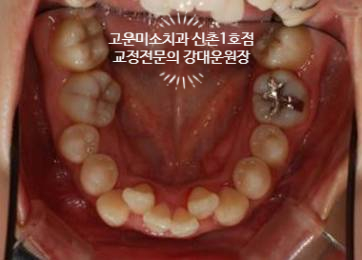  가위교합 파트2
