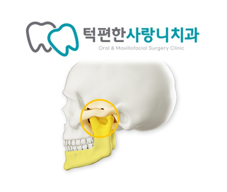  [턱관절 질환의 증상,진단,치료] 보험 적용이 가능한 턱관절 치료? '턱관절 세정술'과 '악관절 고착 해소술'