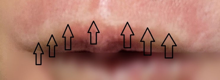 입술 보톡스 (윗입술 세로 주름 보톡스, 필러) 원리 및 효과, 부작용(입술 주름 생기는 이유) - 삼성동 피부과 전문의 닥터림