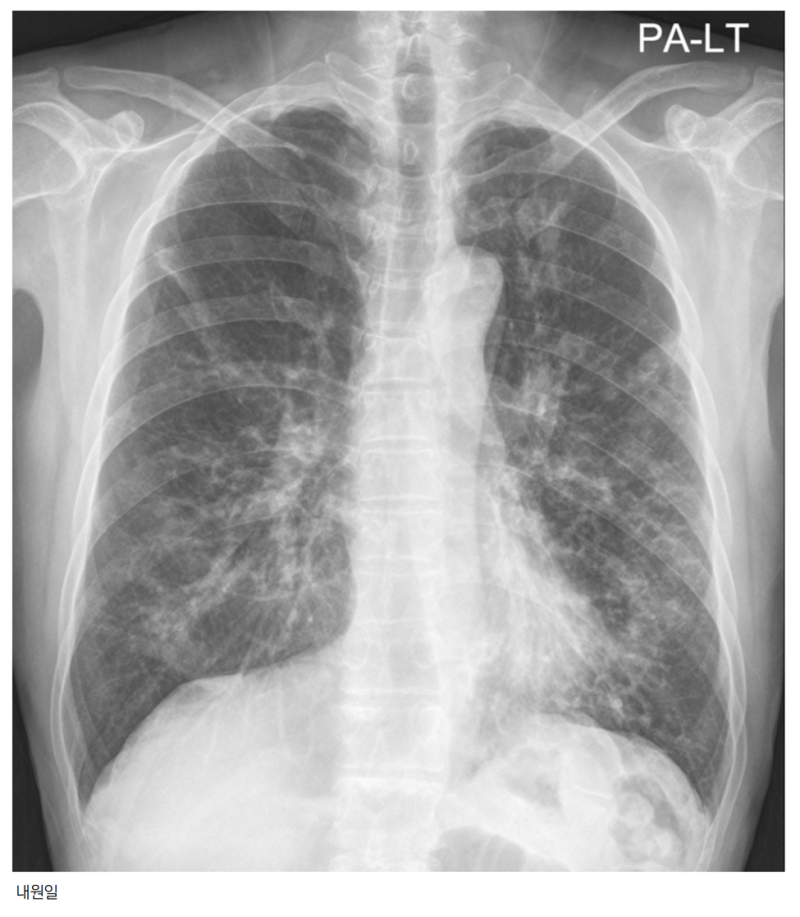 활동성 폐결핵 폐엑스레이 검사 증례, 속립결핵, 기관지확장증, Bronchiectasis, brochial wall ...