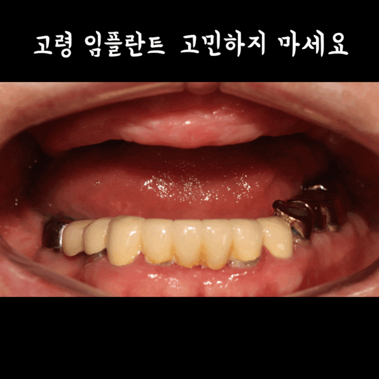  노인 고령환자 문제없는 건강보험 임플란트 수술 치료 방법