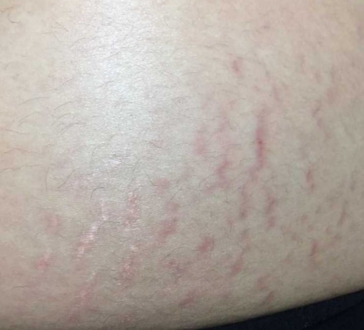 임산부 튼살 없애는법 우먼홈케어 튼살오일 크림 친구 임신 초기 선물 추천 임산부 튼살 없애는법 우먼홈케어 튼살오일 크림 친구 임신 초기 선물 추천