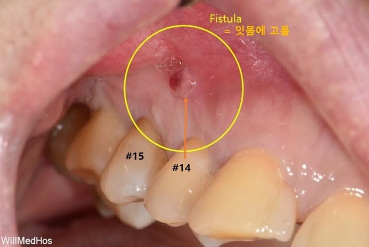  잇몸 염증과 고름 주머니 없어지는 신경 치료 방법