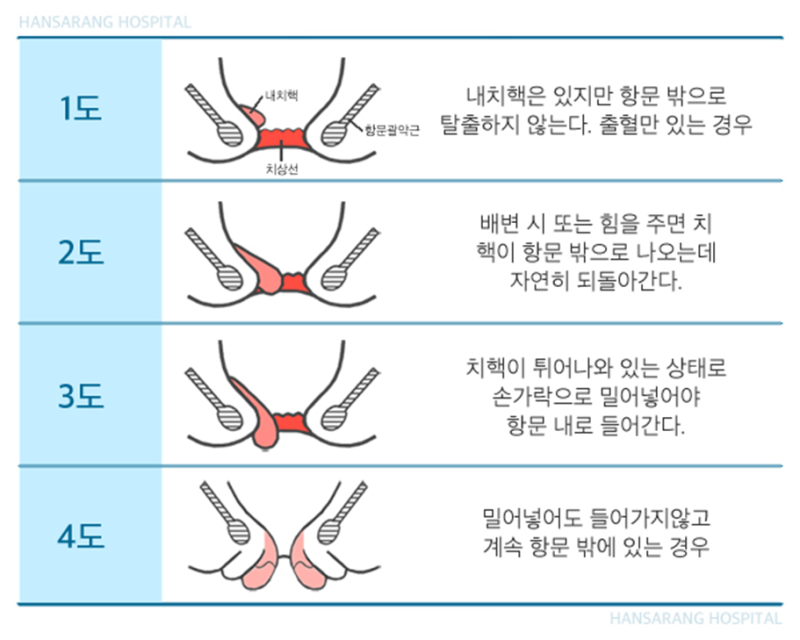 치질약추천/실제사용후비교분석 치질약추천/실제사용후비교분석
